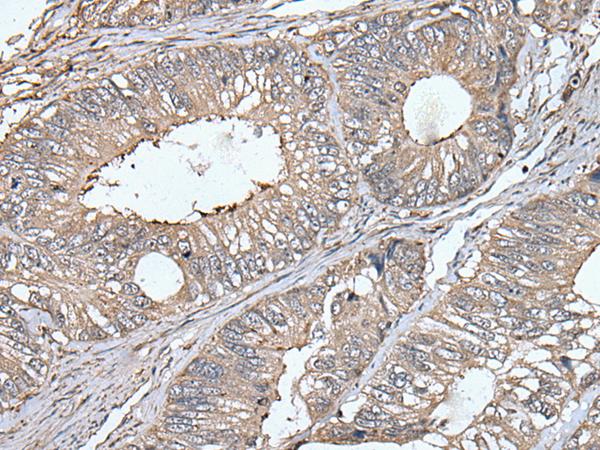 UNC13B Antibody - Immunohistochemistry of paraffin-embedded Human colorectal cancer tissue  using UNC13B Polyclonal Antibody at dilution of 1:40(×200)