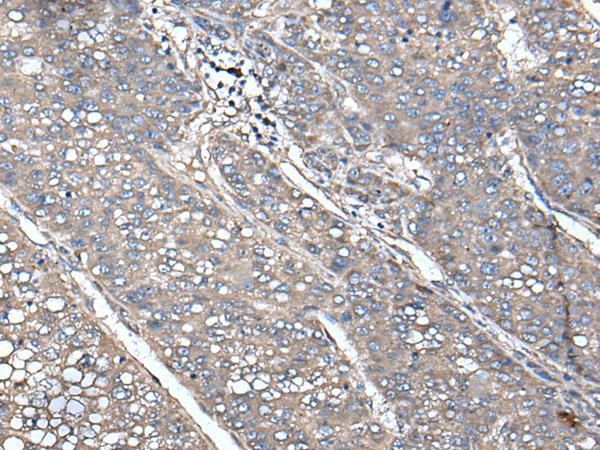 UNC13B Antibody - Immunohistochemistry of paraffin-embedded Human liver cancer tissue  using UNC13B Polyclonal Antibody at dilution of 1:85(×200)