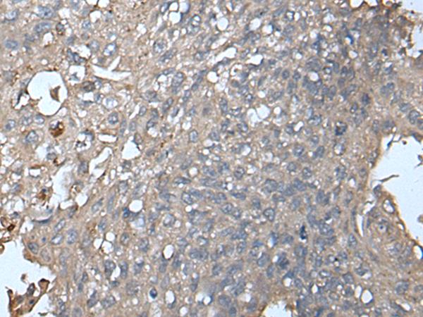 UNC13B Antibody - Immunohistochemistry of paraffin-embedded Human lung cancer tissue  using UNC13B Polyclonal Antibody at dilution of 1:85(×200)