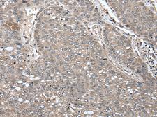 UNC45B Antibody - Immunohistochemistry of paraffin-embedded Human liver cancer tissue  using UNC45B Polyclonal Antibody at dilution of 1:65(×200)