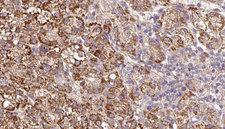 UNC5A Antibody - 1:100 staining human liver carcinoma tissues by IHC-P. The sample was formaldehyde fixed and a heat mediated antigen retrieval step in citrate buffer was performed. The sample was then blocked and incubated with the antibody for 1.5 hours at 22°C. An HRP conjugated goat anti-rabbit antibody was used as the secondary.