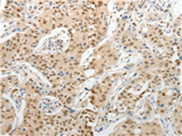 UNC5CL Antibody - Immunohistochemistry of paraffin-embedded Human lung cancer tissue  using UNC5CL Polyclonal Antibody at dilution of 1:50(×200)
