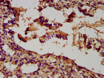 UNC5H2 / UNC5B Antibody - Immunohistochemistry image at a dilution of 1:300 and staining in paraffin-embedded human lung tissue performed on a Leica BondTM system. After dewaxing and hydration, antigen retrieval was mediated by high pressure in a citrate buffer (pH 6.0) . Section was blocked with 10% normal goat serum 30min at RT. Then primary antibody (1% BSA) was incubated at 4 °C overnight. The primary is detected by a biotinylated secondary antibody and visualized using an HRP conjugated SP system.