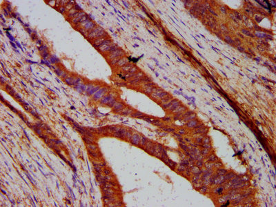 UNC84B / SUN2 Antibody - Immunohistochemistry Dilution at 1:200 and staining in paraffin-embedded human colon cancer performed on a Leica BondTM system. After dewaxing and hydration, antigen retrieval was mediated by high pressure in a citrate buffer (pH 6.0). Section was blocked with 10% normal Goat serum 30min at RT. Then primary antibody (1% BSA) was incubated at 4°C overnight. The primary is detected by a biotinylated Secondary antibody and visualized using an HRP conjugated SP system.