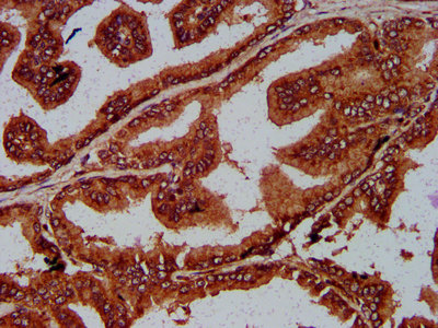 UNC84B / SUN2 Antibody - Immunohistochemistry Dilution at 1:200 and staining in paraffin-embedded human prostate tissue performed on a Leica BondTM system. After dewaxing and hydration, antigen retrieval was mediated by high pressure in a citrate buffer (pH 6.0). Section was blocked with 10% normal Goat serum 30min at RT. Then primary antibody (1% BSA) was incubated at 4°C overnight. The primary is detected by a biotinylated Secondary antibody and visualized using an HRP conjugated SP system.