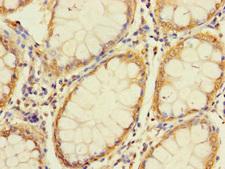 UNC93A Antibody - Immunohistochemistry of paraffin-embedded human colon cancer using UNC93A Antibody at dilution of 1:100
