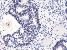 UNG / Uracil DNA Glycosylase Antibody - IHC of paraffin-embedded Adenocarcinoma of Human colon tissue using anti-UNG mouse monoclonal antibody.