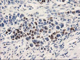 UNG / Uracil DNA Glycosylase Antibody - IHC of paraffin-embedded Carcinoma of Human lung tissue using anti-UNG mouse monoclonal antibody.
