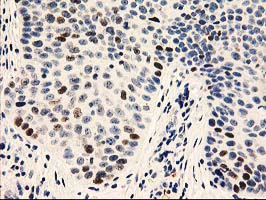 UNG / Uracil DNA Glycosylase Antibody - IHC of paraffin-embedded Carcinoma of Human bladder tissue using anti-UNG mouse monoclonal antibody.