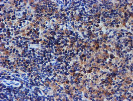 UNG / Uracil DNA Glycosylase Antibody - IHC of paraffin-embedded Human lymphoma tissue using anti-UNG mouse monoclonal antibody. (Heat-induced epitope retrieval by 10mM citric buffer, pH6.0, 100C for 10min).