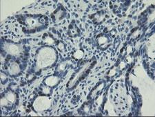 UNG / Uracil DNA Glycosylase Antibody - IHC of paraffin-embedded Adenocarcinoma of Human colon tissue using anti-UNG mouse monoclonal antibody. (Heat-induced epitope retrieval by 10mM citric buffer, pH6.0, 100C for 10min).