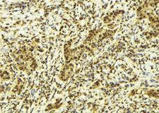 UNG / Uracil DNA Glycosylase Antibody - 1:100 staining human breast carcinoma tissue by IHC-P. The sample was formaldehyde fixed and a heat mediated antigen retrieval step in citrate buffer was performed. The sample was then blocked and incubated with the antibody for 1.5 hours at 22°C. An HRP conjugated goat anti-rabbit antibody was used as the secondary.