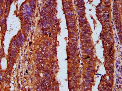UPF3B Antibody - Immunohistochemistry Dilution at 1:500 and staining in paraffin-embedded human colon cancer performed on a Leica BondTM system. After dewaxing and hydration, antigen retrieval was mediated by high pressure in a citrate buffer (pH 6.0). Section was blocked with 10% normal Goat serum 30min at RT. Then primary antibody (1% BSA) was incubated at 4°C overnight. The primary is detected by a biotinylated Secondary antibody and visualized using an HRP conjugated SP system.