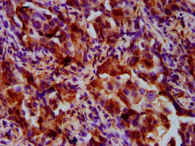 UPF3B Antibody - Immunohistochemistry Dilution at 1:500 and staining in paraffin-embedded human lung cancer performed on a Leica BondTM system. After dewaxing and hydration, antigen retrieval was mediated by high pressure in a citrate buffer (pH 6.0). Section was blocked with 10% normal Goat serum 30min at RT. Then primary antibody (1% BSA) was incubated at 4°C overnight. The primary is detected by a biotinylated Secondary antibody and visualized using an HRP conjugated SP system.
