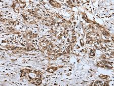 UPK3A / UPK3 / Uroplakin III Antibody - Immunohistochemistry of paraffin-embedded Human gastric cancer tissue  using UPK3A Polyclonal Antibody at dilution of 1:30(×200)