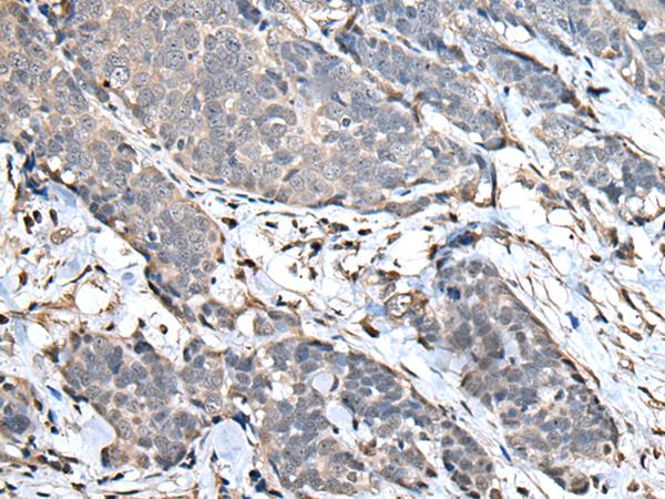 UPK3A / UPK3 / Uroplakin III Antibody - Immunohistochemistry of paraffin-embedded Human thyroid cancer tissue  using UPK3A Polyclonal Antibody at dilution of 1:30(×200)
