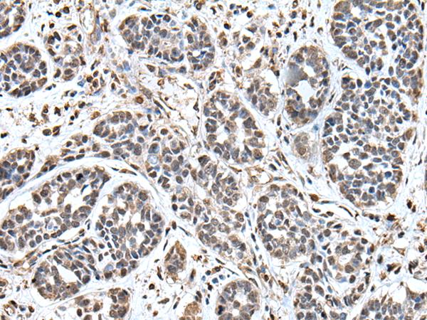 UPK3A / UPK3 / Uroplakin III Antibody - Immunohistochemistry of paraffin-embedded Human esophagus cancer tissue  using UPK3A Polyclonal Antibody at dilution of 1:55(×200)