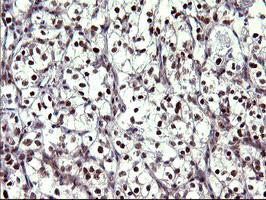 UPRT Antibody - IHC of paraffin-embedded Carcinoma of Human kidney tissue using anti-UPRT mouse monoclonal antibody. (Heat-induced epitope retrieval by 10mM citric buffer, pH6.0, 120°C for 3min).