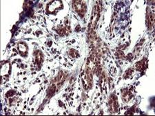 UPRT Antibody - IHC of paraffin-embedded Human breast tissue using anti-UPRT mouse monoclonal antibody. (Heat-induced epitope retrieval by 10mM citric buffer, pH6.0, 120°C for 3min).