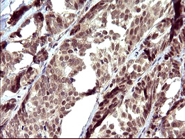 UPRT Antibody - IHC of paraffin-embedded Adenocarcinoma of Human breast tissue using anti-UPRT mouse monoclonal antibody. (Heat-induced epitope retrieval by 10mM citric buffer, pH6.0, 120°C for 3min).