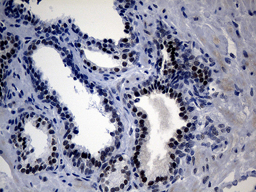 UPRT Antibody - Immunohistochemical staining of paraffin-embedded Carcinoma of Human prostate tissue using anti-UPRT mouse monoclonal antibody. (Heat-induced epitope retrieval by 1mM EDTA in 10mM Tris buffer. (pH8.5) at 120°C for 3 min. (1:500)