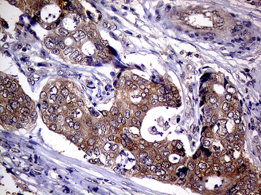 UPRT Antibody - Immunohistochemical staining of paraffin-embedded Adenocarcinoma of Human breast tissue tissue using anti-UPRT mouse monoclonal antibody. (Heat-induced epitope retrieval by 1mM EDTA in 10mM Tris buffer. (pH8.5) at 120°C for 3 min. (1:1000)