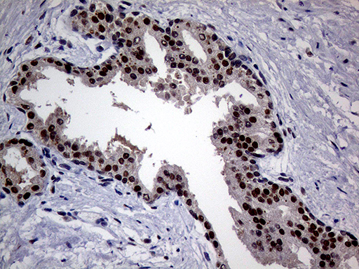 UPRT Antibody - Immunohistochemical staining of paraffin-embedded Carcinoma of Human prostate tissue using anti-UPRT mouse monoclonal antibody. (Heat-induced epitope retrieval by 1mM EDTA in 10mM Tris buffer. (pH8.5) at 120°C for 3 min. (1:1000)