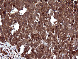 UPRT Antibody - IHC of paraffin-embedded Adenocarcinoma of Human colon tissue using anti-UPRT mouse monoclonal antibody. (Heat-induced epitope retrieval by 10mM citric buffer, pH6.0, 120°C for 3min).