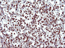 UPRT Antibody - IHC of paraffin-embedded Carcinoma of Human kidney tissue using anti-UPRT mouse monoclonal antibody. (Heat-induced epitope retrieval by 10mM citric buffer, pH6.0, 120°C for 3min).