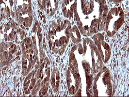 UPRT Antibody - IHC of paraffin-embedded Adenocarcinoma of Human ovary tissue using anti-UPRT mouse monoclonal antibody. (Heat-induced epitope retrieval by 10mM citric buffer, pH6.0, 120°C for 3min).