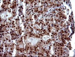UPRT Antibody - IHC of paraffin-embedded Carcinoma of Human thyroid tissue using anti-UPRT mouse monoclonal antibody. (Heat-induced epitope retrieval by 10mM citric buffer, pH6.0, 120°C for 3min).