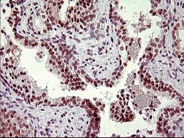 UPRT Antibody - IHC of paraffin-embedded Carcinoma of Human prostate tissue using anti-UPRT mouse monoclonal antibody. (Heat-induced epitope retrieval by 10mM citric buffer, pH6.0, 120°C for 3min).