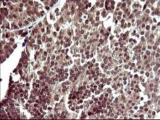 UPRT Antibody - IHC of paraffin-embedded Adenocarcinoma of Human breast tissue using anti-UPRT mouse monoclonal antibody. (Heat-induced epitope retrieval by 10mM citric buffer, pH6.0, 120°C for 3min).