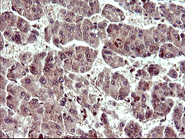 UPRT Antibody - IHC of paraffin-embedded Carcinoma of Human liver tissue using anti-UPRT mouse monoclonal antibody. (Heat-induced epitope retrieval by 10mM citric buffer, pH6.0, 120°C for 3min).