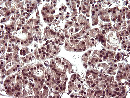 UPRT Antibody - IHC of paraffin-embedded Carcinoma of Human thyroid tissue using anti-UPRT mouse monoclonal antibody. (Heat-induced epitope retrieval by 10mM citric buffer, pH6.0, 120°C for 3min).