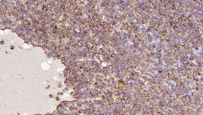 UQCRC1 Antibody - 1:100 staining human lymph carcinoma tissue by IHC-P. The sample was formaldehyde fixed and a heat mediated antigen retrieval step in citrate buffer was performed. The sample was then blocked and incubated with the antibody for 1.5 hours at 22°C. An HRP conjugated goat anti-rabbit antibody was used as the secondary.