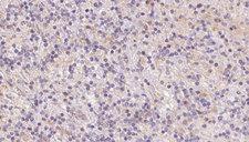 UQCRFS1 Antibody - 1:100 staining human lymph carcinoma tissue by IHC-P. The sample was formaldehyde fixed and a heat mediated antigen retrieval step in citrate buffer was performed. The sample was then blocked and incubated with the antibody for 1.5 hours at 22°C. An HRP conjugated goat anti-rabbit antibody was used as the secondary.