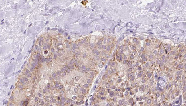 UQCRQ Antibody - 1:100 staining human thyroid carcinoma tissue by IHC-P. The sample was formaldehyde fixed and a heat mediated antigen retrieval step in citrate buffer was performed. The sample was then blocked and incubated with the antibody for 1.5 hours at 22°C. An HRP conjugated goat anti-rabbit antibody was used as the secondary.