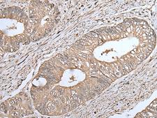 UQCRQ Antibody - Immunohistochemistry of paraffin-embedded Human colorectal cancer tissue  using UQCRQ Polyclonal Antibody at dilution of 1:45(×200)