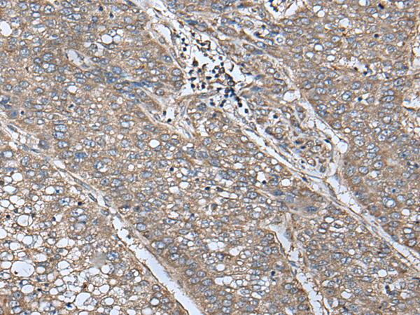 UQCRQ Antibody - Immunohistochemistry of paraffin-embedded Human liver cancer tissue  using UQCRQ Polyclonal Antibody at dilution of 1:50(×200)