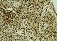 URI1 / NNX3 Antibody - 1:100 staining human breast carcinoma tissue by IHC-P. The sample was formaldehyde fixed and a heat mediated antigen retrieval step in citrate buffer was performed. The sample was then blocked and incubated with the antibody for 1.5 hours at 22°C. An HRP conjugated goat anti-rabbit antibody was used as the secondary.