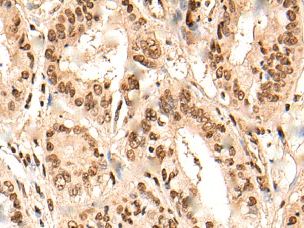 URI1 / NNX3 Antibody - Immunohistochemistry of paraffin-embedded Human liver cancer tissue  using URI1 Polyclonal Antibody at dilution of 1:45(×200)