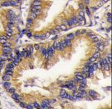 URM1 Antibody - Formalin-fixed and paraffin-embedded human lung carcinoma tissue reacted with URM1 Antibody , which was peroxidase-conjugated to the secondary antibody, followed by DAB staining. This data demonstrates the use of this antibody for immunohistochemistry; clinical relevance has not been evaluated.