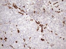 URP2 / FERMT3 Antibody - Immunohistochemical staining of paraffin-embedded Adenocarcinoma of Human endometrium tissue using anti-FERMT3 mouse monoclonal antibody. (Heat-induced epitope retrieval by 1mM EDTA in 10mM Tris buffer. (pH8.5) at 120 oC for 3 min. (1:150)