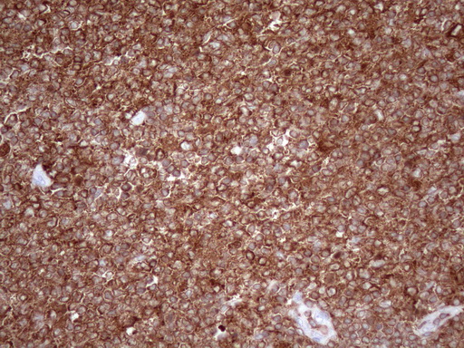 URP2 / FERMT3 Antibody - Immunohistochemical staining of paraffin-embedded Human lymphoma tissue using anti-FERMT3 mouse monoclonal antibody. (Heat-induced epitope retrieval by 1mM EDTA in 10mM Tris buffer. (pH8.5) at 120 oC for 3 min. (1:150)