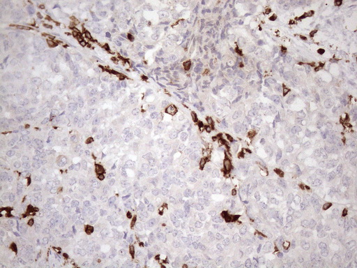 URP2 / FERMT3 Antibody - Immunohistochemical staining of paraffin-embedded Adenocarcinoma of Human endometrium tissue using anti-FERMT3 mouse monoclonal antibody. (Heat-induced epitope retrieval by 1mM EDTA in 10mM Tris buffer. (pH8.5) at 120 oC for 3 min. (1:150)