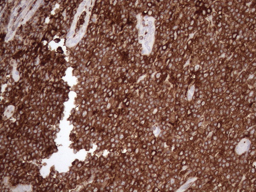 URP2 / FERMT3 Antibody - Immunohistochemical staining of paraffin-embedded Human lymph node tissue within the normal limits using anti-FERMT3 mouse monoclonal antibody. (Heat-induced epitope retrieval by 1mM EDTA in 10mM Tris buffer. (pH8.5) at 120 oC for 3 min. (1:150)