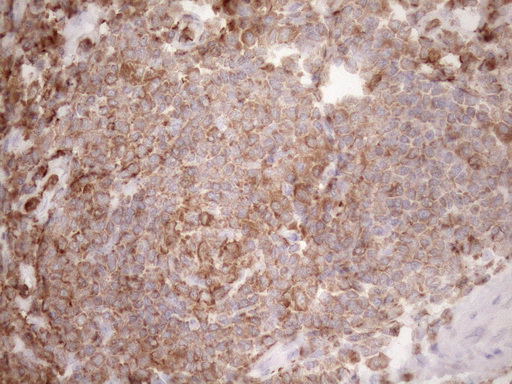 URP2 / FERMT3 Antibody - Immunohistochemical staining of paraffin-embedded Adenocarcinoma of Human colon tissue using anti-FERMT3 mouse monoclonal antibody. (Heat-induced epitope retrieval by 1mM EDTA in 10mM Tris buffer. (pH8.5) at 120 oC for 3 min. (1:150)