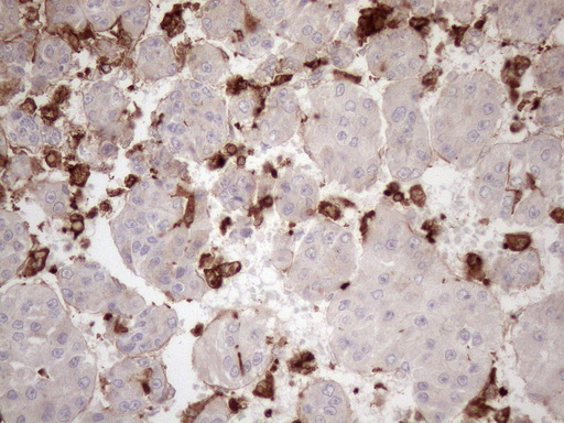URP2 / FERMT3 Antibody - Immunohistochemical staining of paraffin-embedded Carcinoma of Human liver tissue using anti-FERMT3 mouse monoclonal antibody. (Heat-induced epitope retrieval by 1mM EDTA in 10mM Tris buffer. (pH8.5) at 120 oC for 3 min. (1:150)