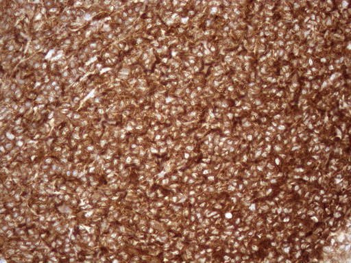 URP2 / FERMT3 Antibody - Immunohistochemical staining of paraffin-embedded Human lymphoma tissue using anti-FERMT3 mouse monoclonal antibody. (Heat-induced epitope retrieval by 1mM EDTA in 10mM Tris buffer. (pH8.5) at 120 oC for 3 min. (1:150)